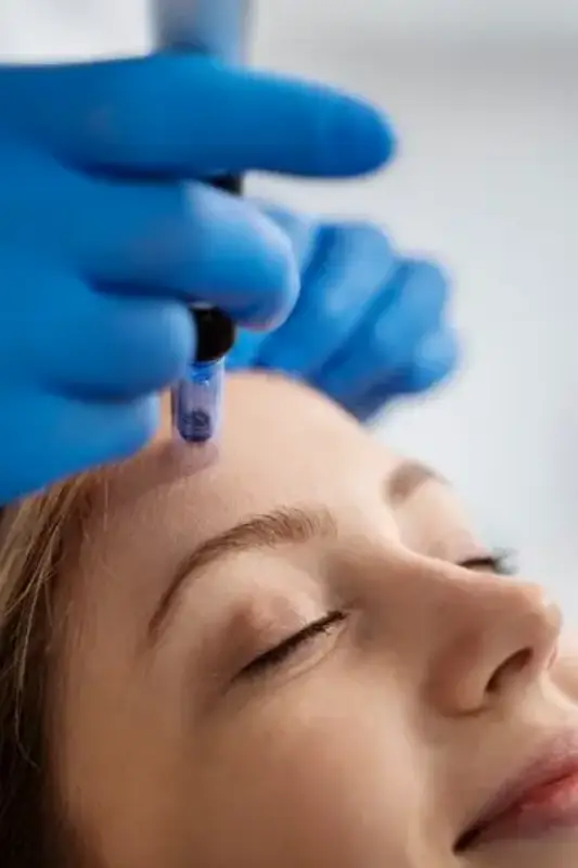 Microagulhamento facial preço